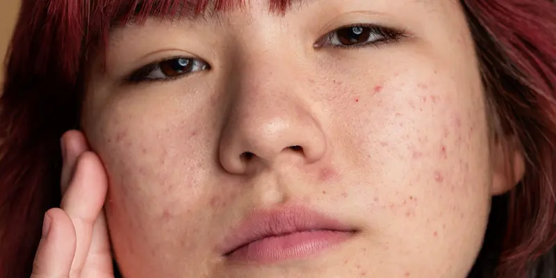 problèmes dermatologiques sur le visage